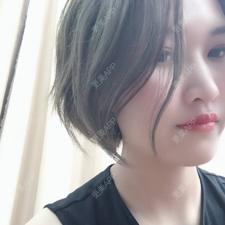 更美 - 俞俞正的自体脂肪全面部填充经验 | 自体脂肪全面部填充 | 杭州 | 更美研究所 | 自体脂肪丰面颊 | 视频日记