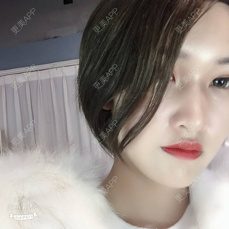 更美 - 俞俞正的自体脂肪全面部填充经验 | 自体脂肪全面部填充 | 杭州 | 更美研究所 | 自体脂肪丰面颊 | 视频日记