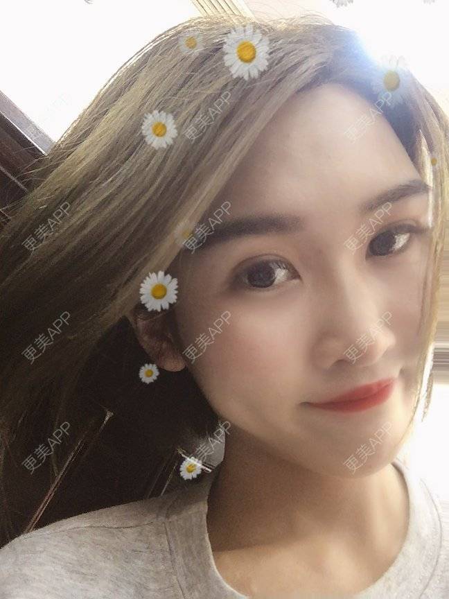 更美 - 俞俞正的自体脂肪全面部填充经验 | 自体脂肪全面部填充 | 杭州 | 更美研究所 | 自体脂肪丰面颊 | 视频日记