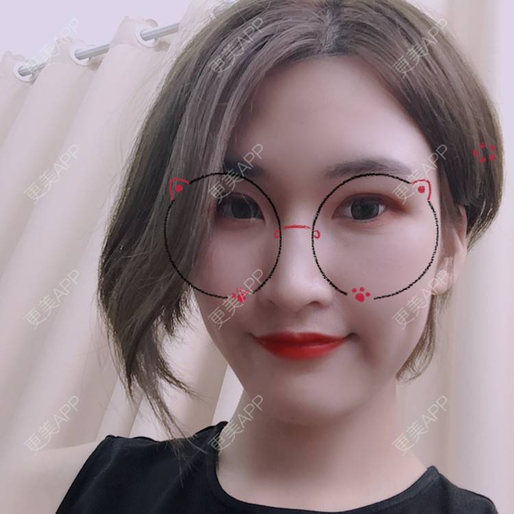 更美 - 俞俞正的自体脂肪全面部填充经验 | 自体脂肪全面部填充 | 杭州 | 更美研究所 | 自体脂肪丰面颊 | 视频日记