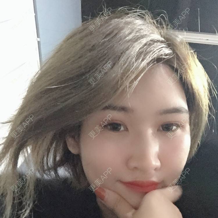 更美 - 俞俞正的自体脂肪全面部填充经验 | 自体脂肪全面部填充 | 杭州 | 更美研究所 | 自体脂肪丰面颊 | 视频日记