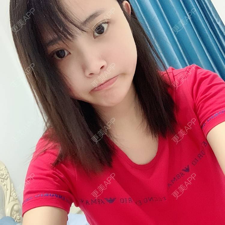 更美 - 大美人图的自体脂肪丰额头经验 | 更美研究所 | 自体脂肪丰额头 | 杭州