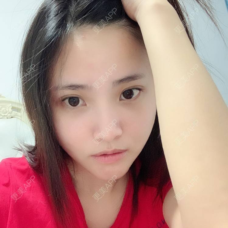 更美 - 大美人图的自体脂肪丰额头经验 | 更美研究所 | 自体脂肪丰额头 | 杭州