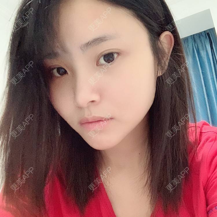 更美 - 大美人图的自体脂肪丰额头经验 | 更美研究所 | 自体脂肪丰额头 | 杭州