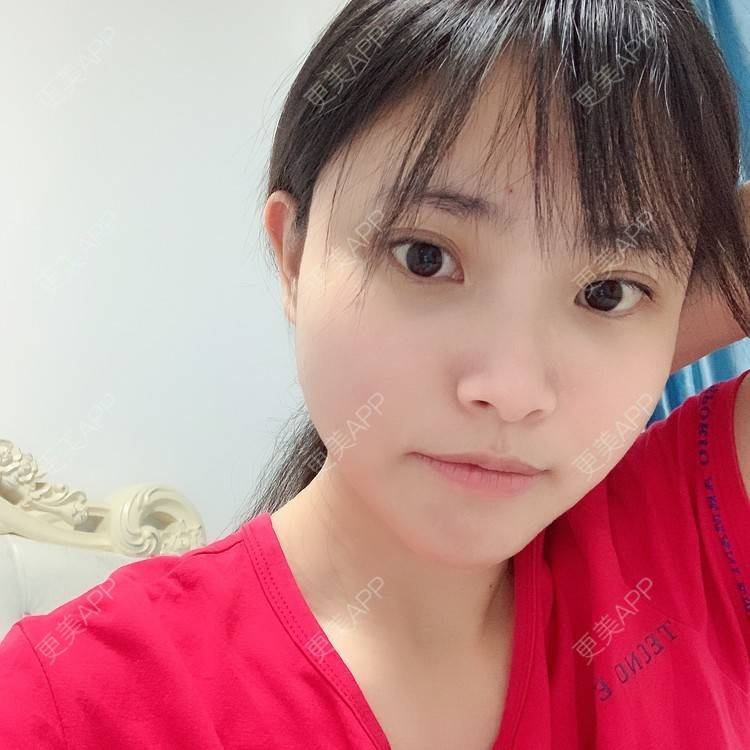 更美 - 大美人图的自体脂肪丰额头经验 | 更美研究所 | 自体脂肪丰额头 | 杭州