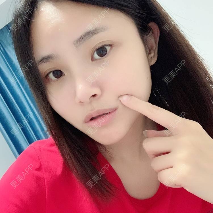 更美 - 大美人图的自体脂肪丰额头经验 | 更美研究所 | 自体脂肪丰额头 | 杭州