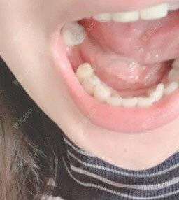 更美 - 汤姆的小情人押的种植牙齿经验 | 种植牙齿 | 北京