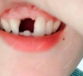 更美 - 快递哥哥，的种植牙齿经验 | 种植牙齿 | 北京