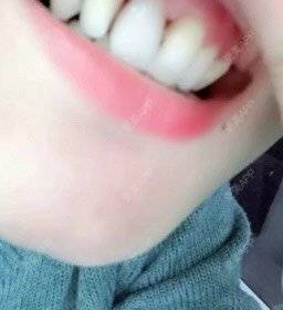 更美 - 快递哥哥，的种植牙齿经验 | 种植牙齿 | 北京