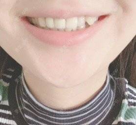 更美 - 汤姆的小情人押的种植牙齿经验 | 种植牙齿 | 北京