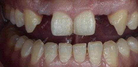 更美 - 快递哥哥，的种植牙齿经验 | 种植牙齿 | 北京