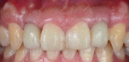 更美 - 快递哥哥，的种植牙齿经验 | 种植牙齿 | 北京