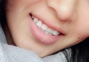 更美 - 迟醉交的种植牙齿经验 | 种植牙齿 | 北京