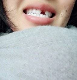 更美 - 迟醉交的种植牙齿经验 | 种植牙齿 | 北京