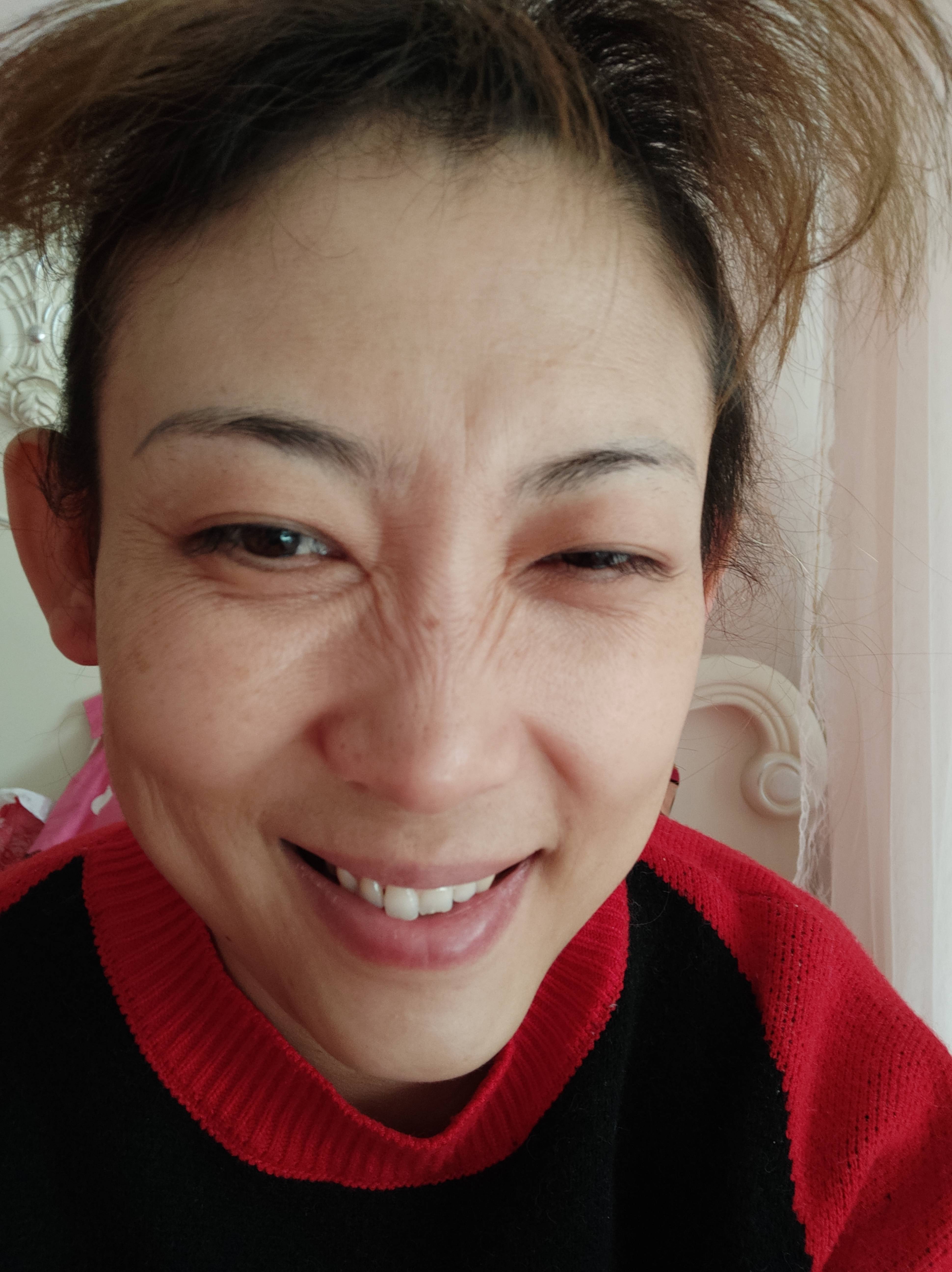 保定蓝山刘海涛是眼科医生吗?注射瘦脸?注射瘦脸术后三个月真实野生反馈