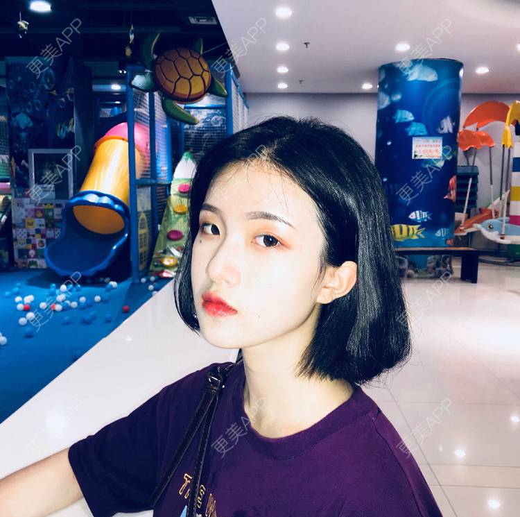 更美 - 罗兰儿的牙齿瓷贴面经验 | 成都 | 牙齿瓷贴面