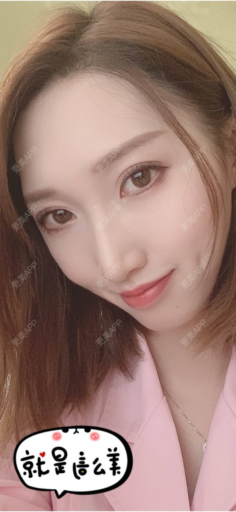 更美 - 兮颜～的酒窝成形经验 | 酒窝成形 | 上海