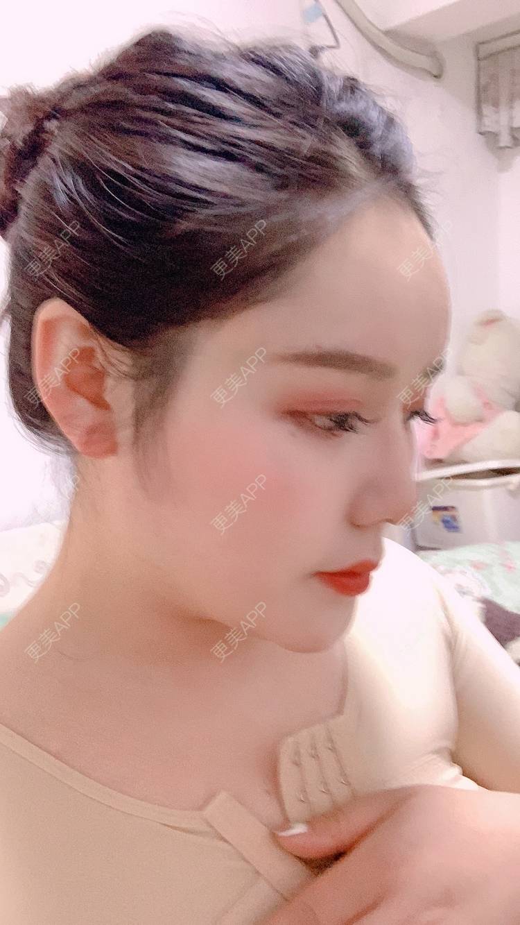 更美 - 更美用户dapPewZ45A的自体脂肪丰额头经验 | 自体脂肪丰额头 | 重庆