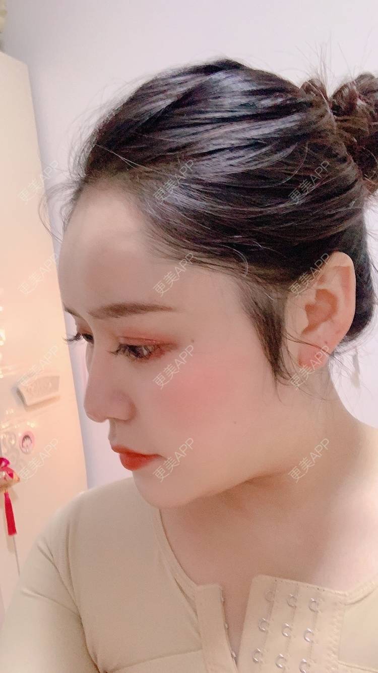 更美 - 更美用户dapPewZ45A的自体脂肪丰额头经验 | 自体脂肪丰额头 | 重庆