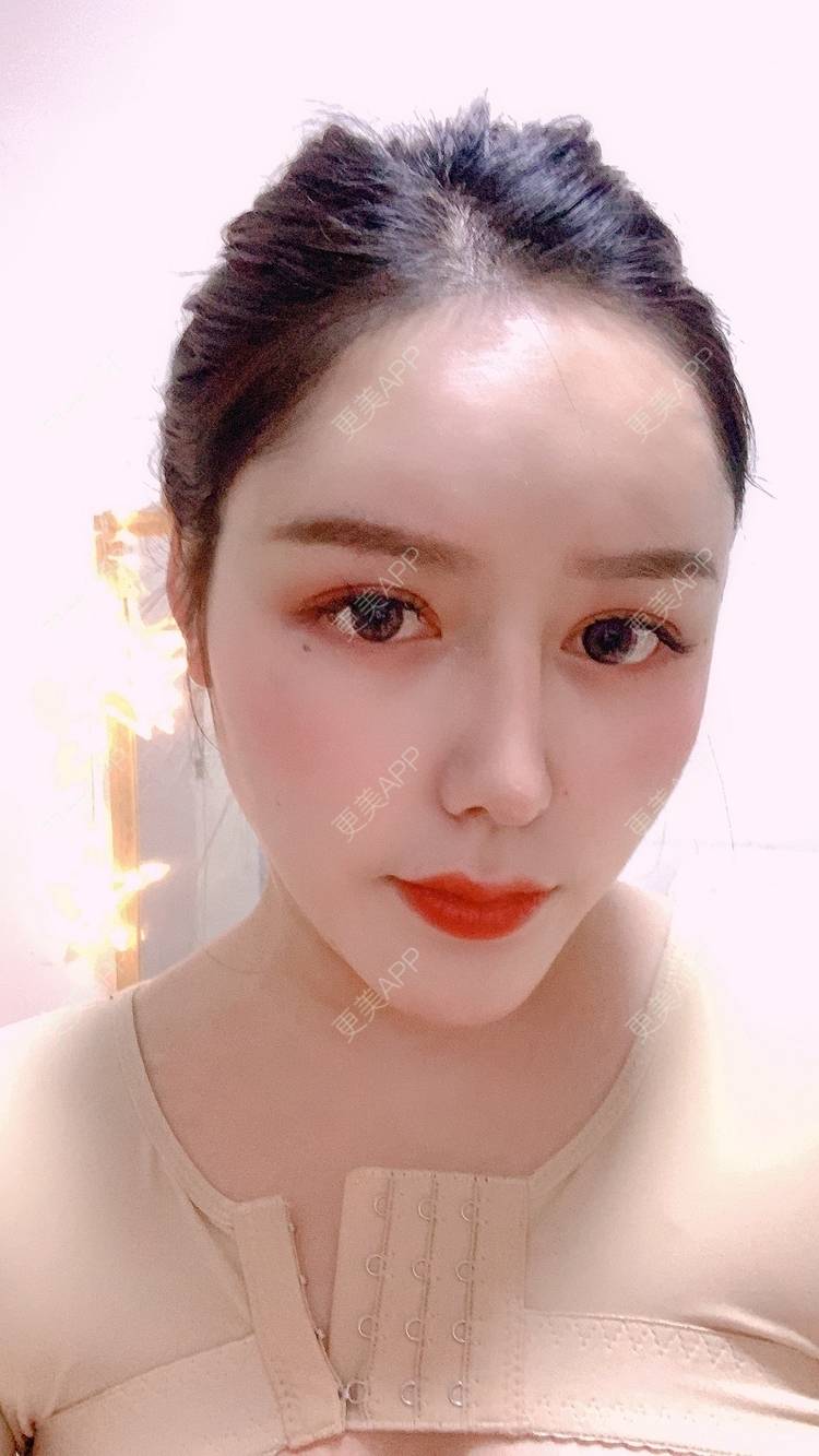 更美 - 更美用户dapPewZ45A的自体脂肪丰额头经验 | 自体脂肪丰额头 | 重庆