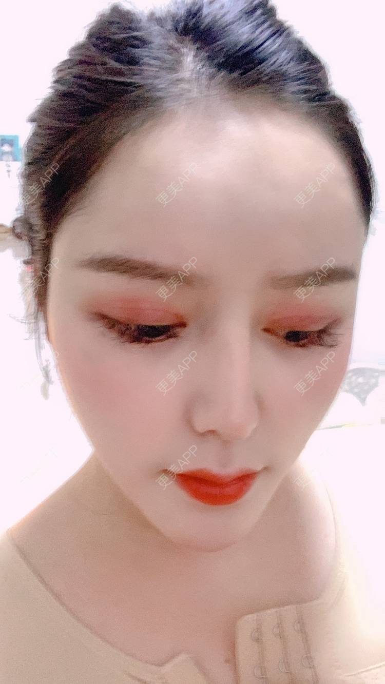 更美 - 更美用户dapPewZ45A的自体脂肪丰额头经验 | 自体脂肪丰额头 | 重庆