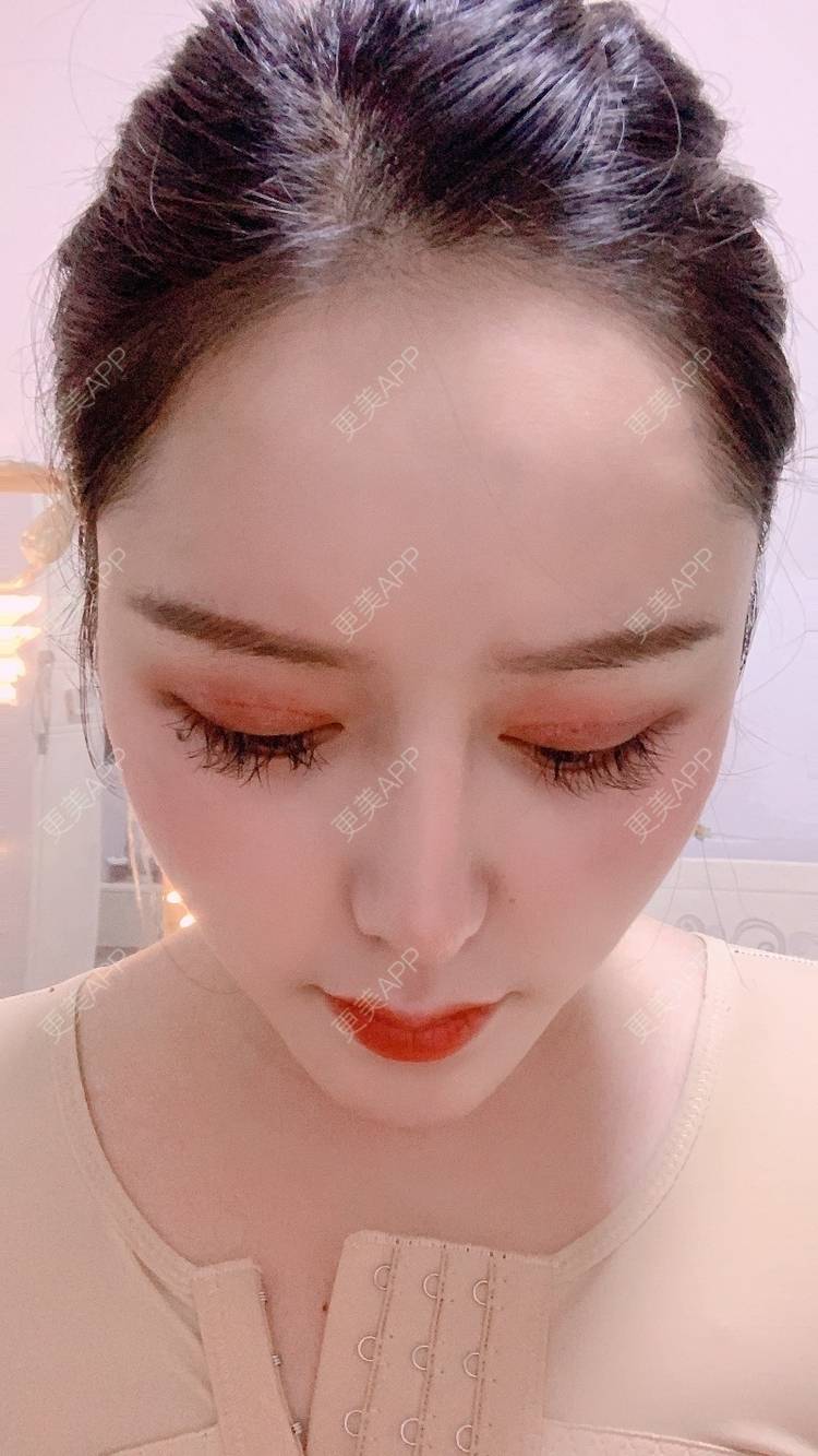 更美 - 更美用户dapPewZ45A的自体脂肪丰额头经验 | 自体脂肪丰额头 | 重庆