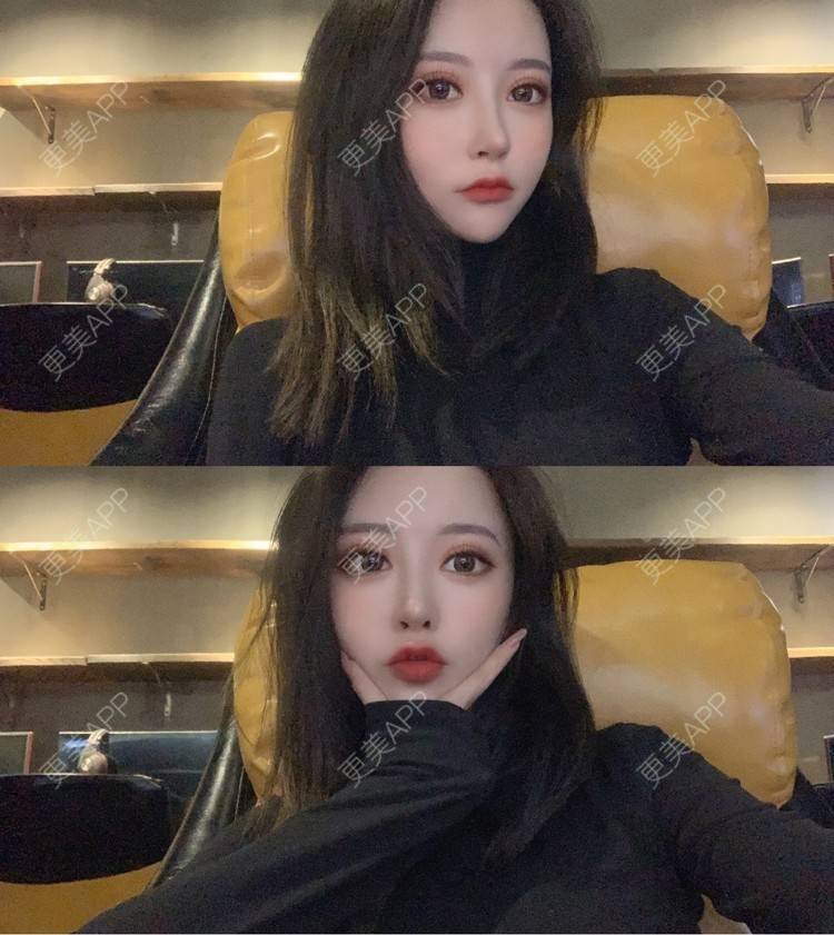 更美 - 小邵的糖🧸的鼻部多项经验 | 耳软骨隆鼻 | 鼻部多项 | 鼻小柱延长 | 自体软骨垫鼻尖 | 长春