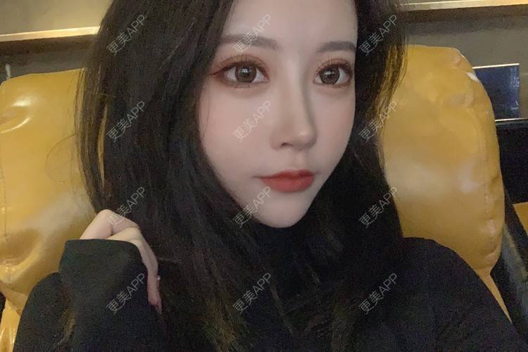 更美 - 小邵的糖🧸的鼻部多项经验 | 耳软骨隆鼻 | 鼻部多项 | 鼻小柱延长 | 自体软骨垫鼻尖 | 长春