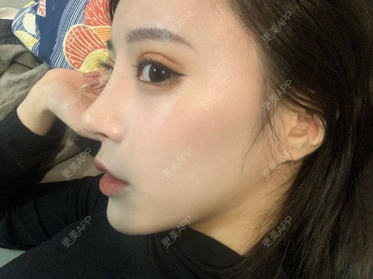 更美 - 小邵的糖🧸的鼻部多项经验 | 耳软骨隆鼻 | 鼻部多项 | 鼻小柱延长 | 自体软骨垫鼻尖 | 长春