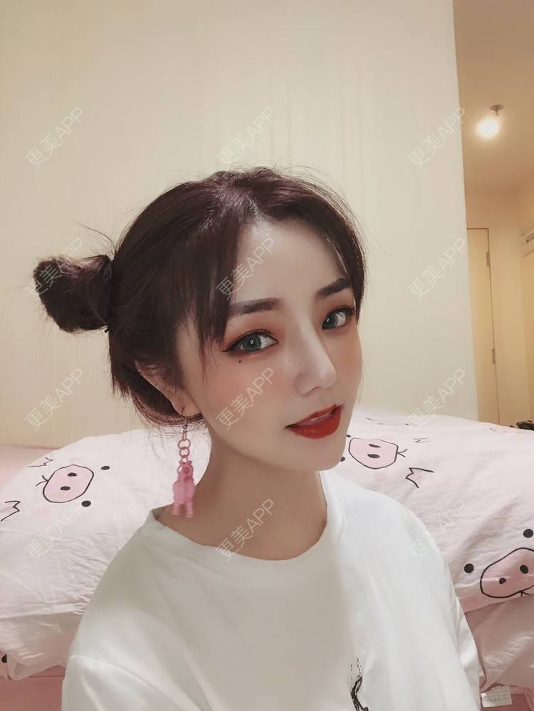 鼻翼缩小整形_camped鼻翼缩小整形_术后198天__更美