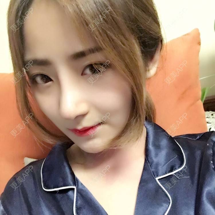 更美 - 更美用户qmLmUIMryz的肋软骨隆鼻经验 | 南阳 | 肋软骨隆鼻