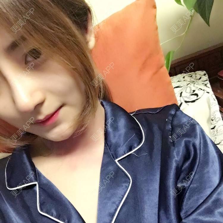 更美 - 更美用户qmLmUIMryz的肋软骨隆鼻经验 | 南阳 | 肋软骨隆鼻