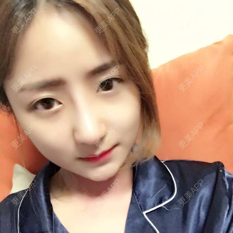 更美 - 更美用户qmLmUIMryz的肋软骨隆鼻经验 | 南阳 | 肋软骨隆鼻