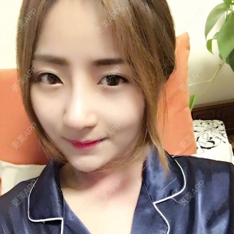 更美 - 更美用户qmLmUIMryz的肋软骨隆鼻经验 | 南阳 | 肋软骨隆鼻