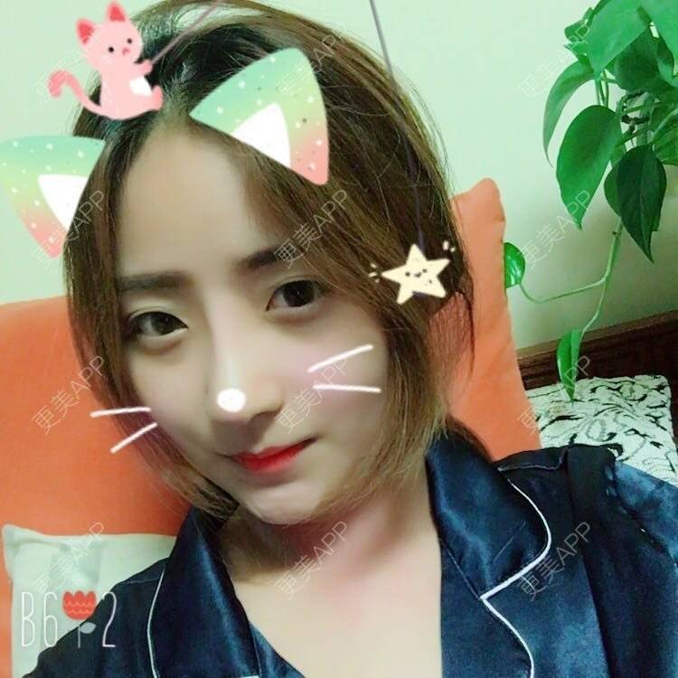 更美 - 更美用户qmLmUIMryz的肋软骨隆鼻经验 | 南阳 | 肋软骨隆鼻