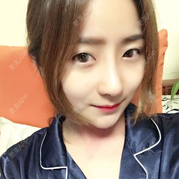 更美 - 更美用户qmLmUIMryz的肋软骨隆鼻经验 | 南阳 | 肋软骨隆鼻