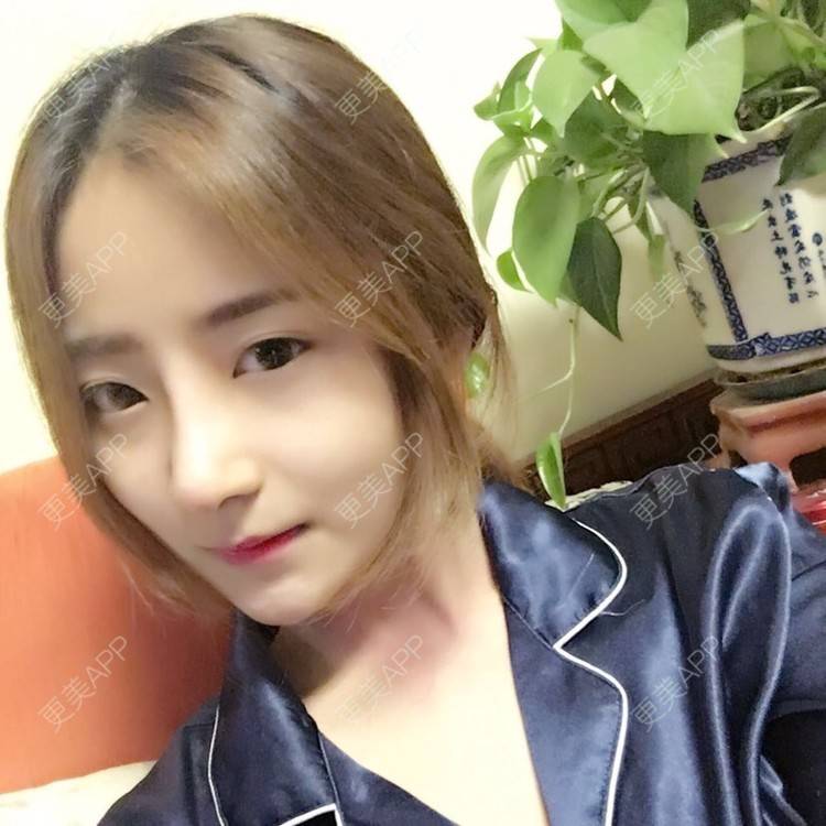 更美 - 更美用户qmLmUIMryz的肋软骨隆鼻经验 | 南阳 | 肋软骨隆鼻