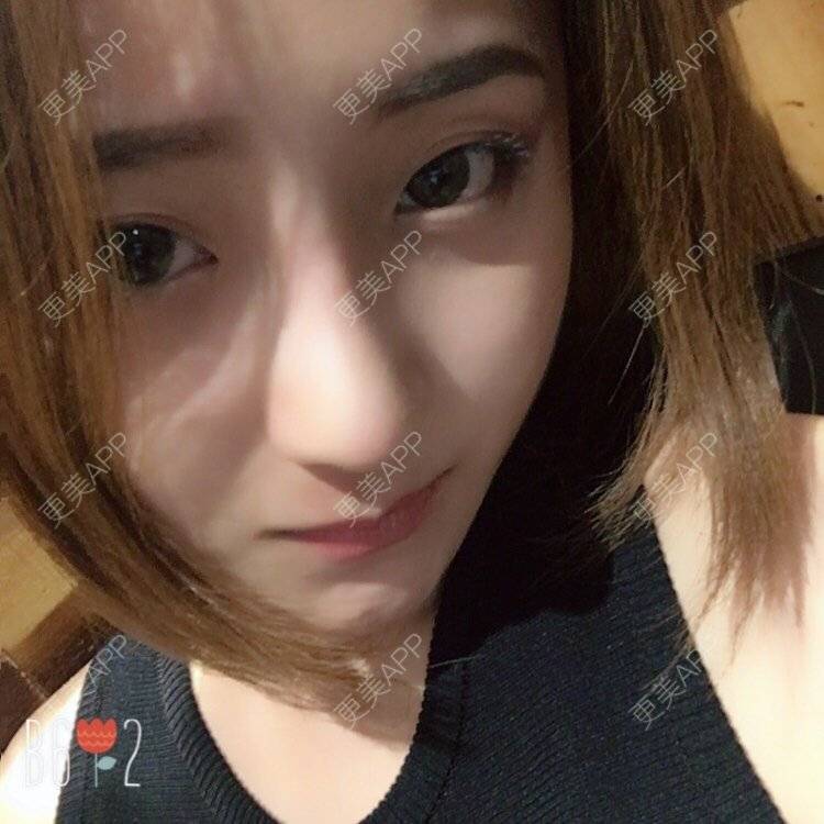 更美 - 更美用户qmLmUIMryz的肋软骨隆鼻经验 | 南阳 | 肋软骨隆鼻