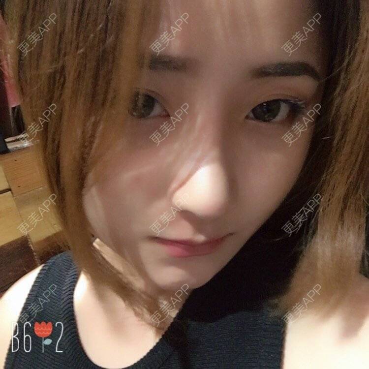 更美 - 更美用户qmLmUIMryz的肋软骨隆鼻经验 | 南阳 | 肋软骨隆鼻