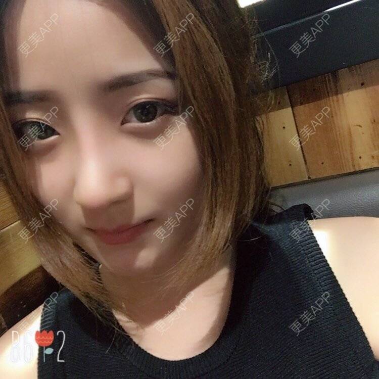 更美 - 更美用户qmLmUIMryz的肋软骨隆鼻经验 | 南阳 | 肋软骨隆鼻