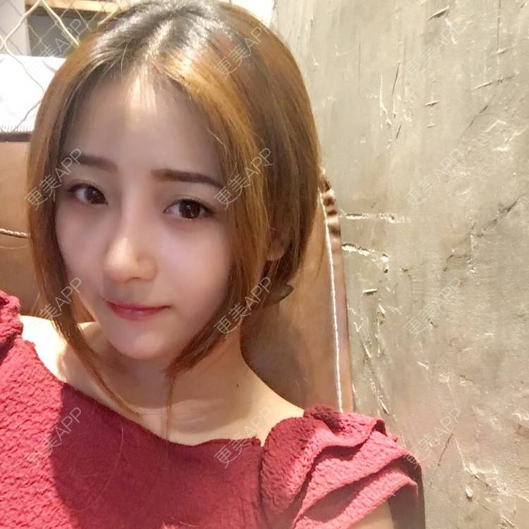 更美 - 更美用户qmLmUIMryz的肋软骨隆鼻经验 | 南阳 | 肋软骨隆鼻
