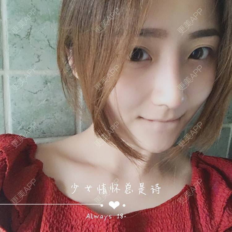 更美 - 更美用户qmLmUIMryz的肋软骨隆鼻经验 | 南阳 | 肋软骨隆鼻