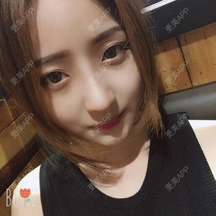 更美 - 更美用户qmLmUIMryz的肋软骨隆鼻经验 | 南阳 | 肋软骨隆鼻