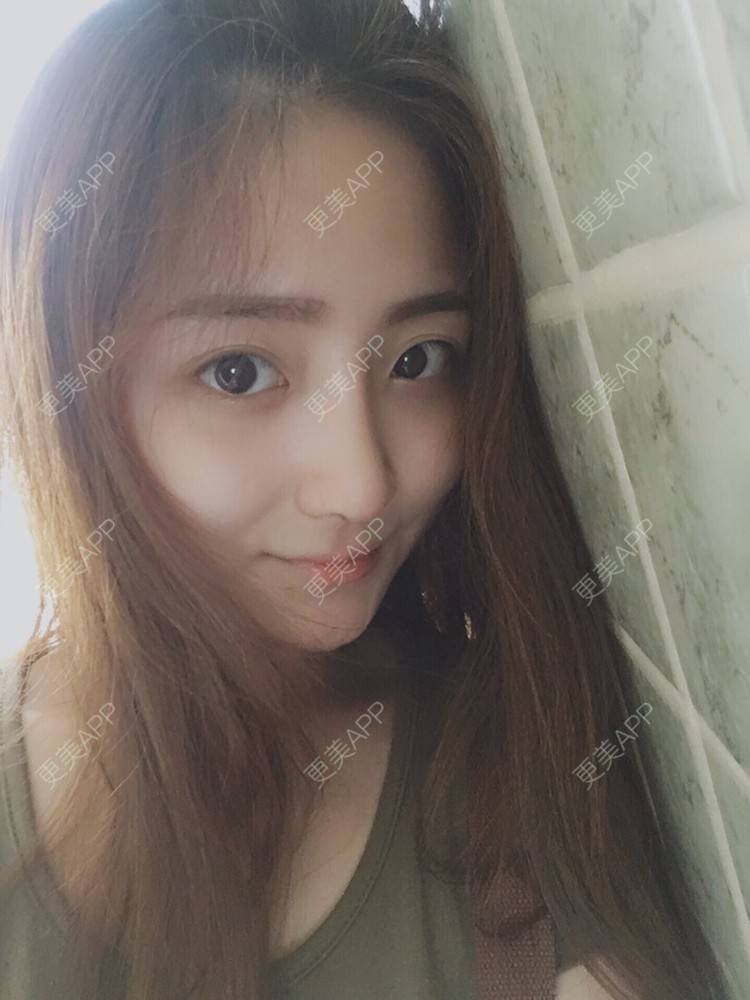更美 - 更美用户qmLmUIMryz的肋软骨隆鼻经验 | 南阳 | 肋软骨隆鼻