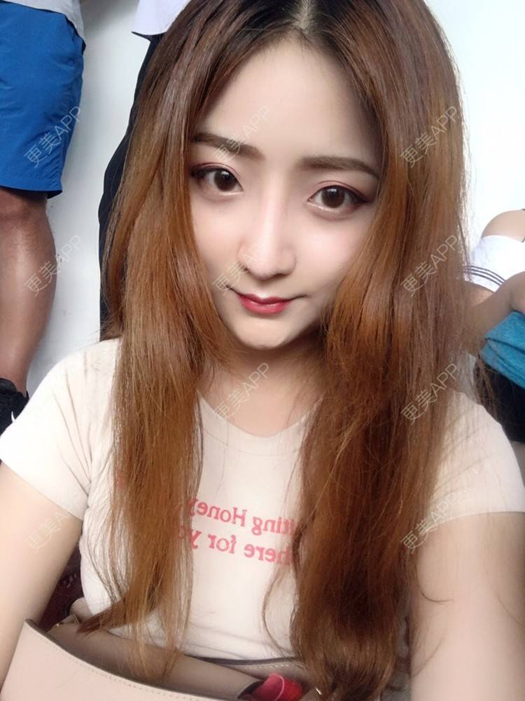 更美 - 更美用户qmLmUIMryz的肋软骨隆鼻经验 | 肋软骨隆鼻 | 南阳