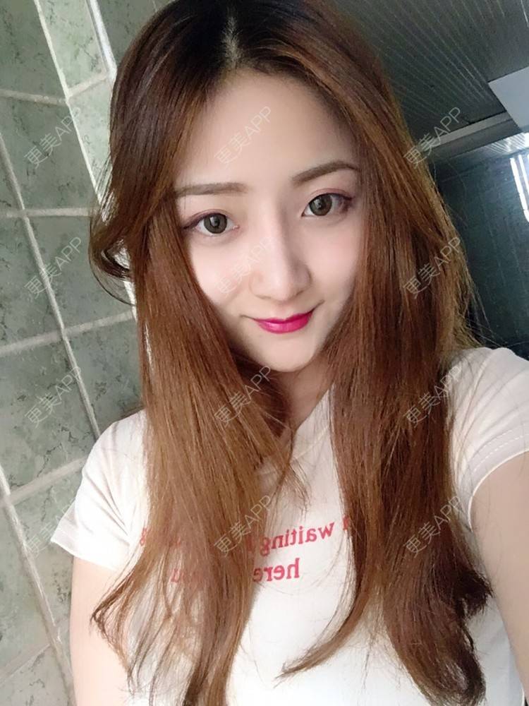 更美 - 更美用户qmLmUIMryz的肋软骨隆鼻经验 | 肋软骨隆鼻 | 南阳