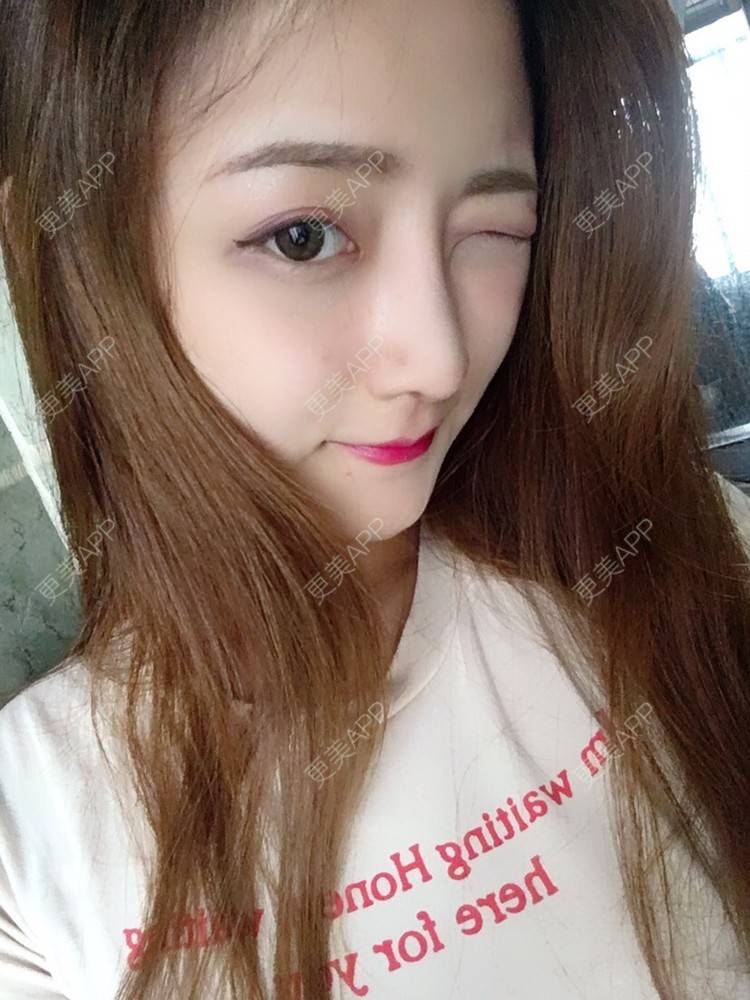 更美 - 更美用户qmLmUIMryz的肋软骨隆鼻经验 | 肋软骨隆鼻 | 南阳