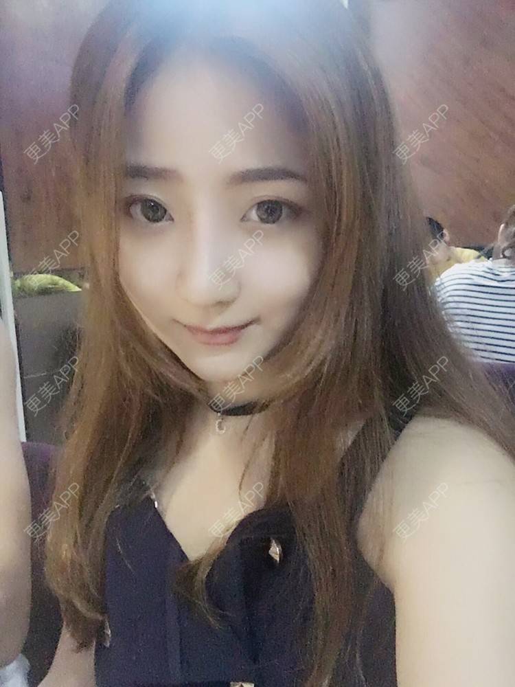 更美 - 更美用户qmLmUIMryz的肋软骨隆鼻经验 | 肋软骨隆鼻 | 南阳