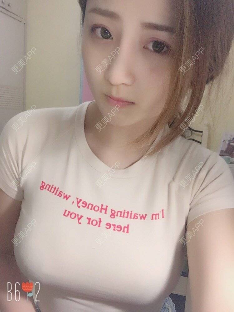 更美 - 更美用户qmLmUIMryz的肋软骨隆鼻经验 | 肋软骨隆鼻 | 南阳