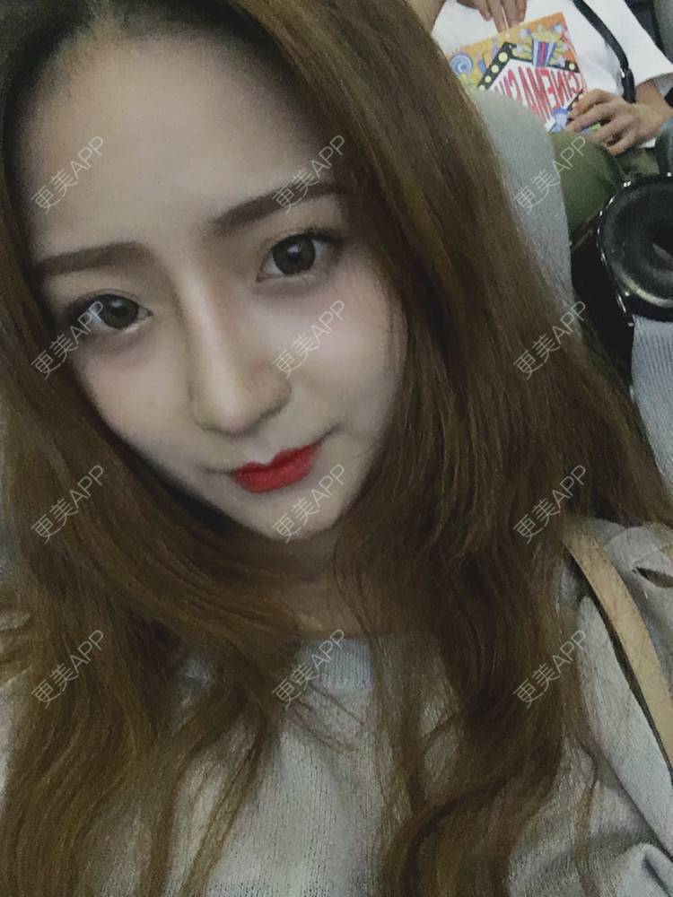 更美 - 更美用户qmLmUIMryz的肋软骨隆鼻经验 | 肋软骨隆鼻 | 南阳
